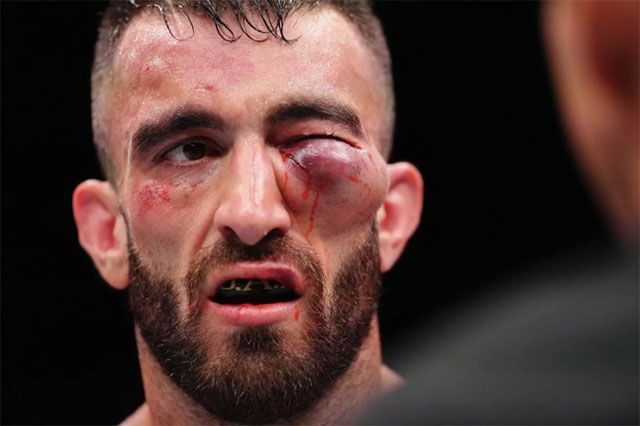 Mohammed Yahya's left eye area is swollen 