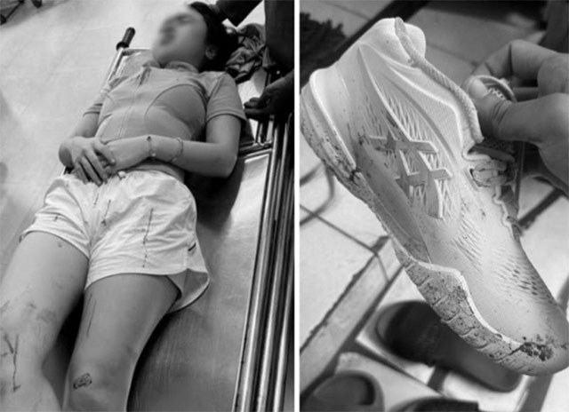 The girl playing pickleball was hospitalized because she was thrown in her forehead
